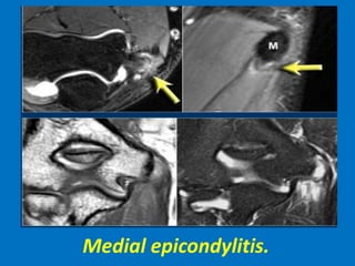 Medial epicondylitis.
 