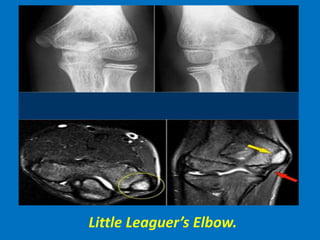 Little Leaguer’s Elbow.
 