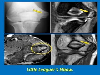 Little Leaguer’s Elbow.
 