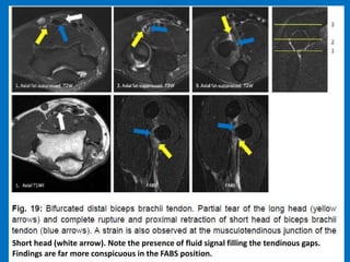 Short head (white arrow). Note the presence of fluid signal filling the tendinous gaps.
Findings are far more conspicuous in the FABS position.
 