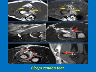 Biceps tendon tear.
 
