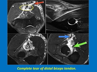 Complete tear of distal biceps tendon.
 