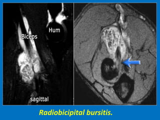 Radiobicipital bursitis.
 
