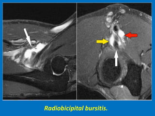 Radiobicipital bursitis.
 