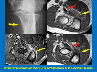 Chronic type of avulsion injury with partial tearing of the Brachials tendon.
 