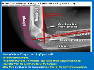Normal elbow X-ray - Lateral - (7 year old)
Normal anterior fat pad.
The posterior fat pad is not visible - soft tissue of the triceps muscle is not
separated from the posterior edge of the humerus.
More than one third of the capitulum lies in front of the anterior humerus line.
 