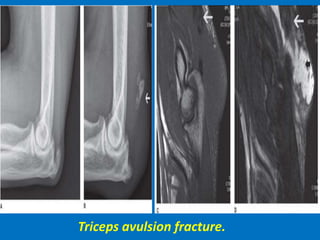 Triceps avulsion fracture.
 