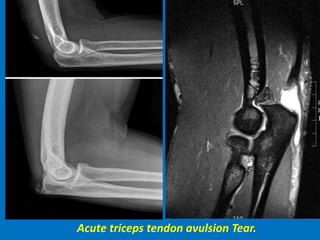 Acute triceps tendon avulsion Tear.
 