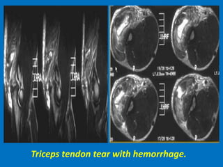 Triceps tendon tear with hemorrhage.
 
