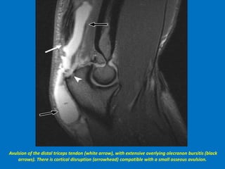 Avulsion of the distal triceps tendon (white arrow), with extensive overlying olecranon bursitis (black
arrows). There is cortical disruption (arrowhead) compatible with a small osseous avulsion.
 