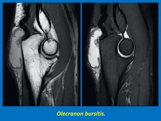 Olecranon bursitis.
 