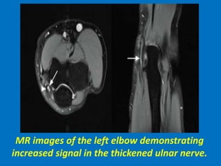 MR images of the left elbow demonstrating
increased signal in the thickened ulnar nerve.
 