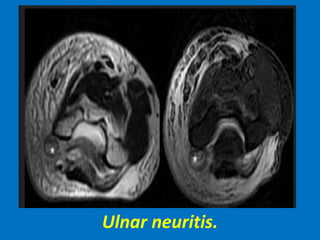 Ulnar neuritis.
 