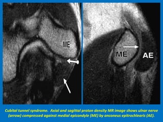 Cubital tunnel syndrome. Axial and sagittal proton density MR image shows ulnar nerve
(arrow) compressed against medial epicondyle (ME) by anconeus epitrochlearis (AE).
 