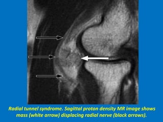 Radial tunnel syndrome. Sagittal proton density MR image shows
mass (white arrow) displacing radial nerve (black arrows).
 
