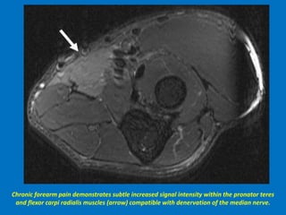 Chronic forearm pain demonstrates subtle increased signal intensity within the pronator teres
and flexor carpi radialis muscles (arrow) compatible with denervation of the median nerve.
 