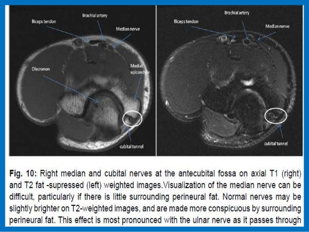 Presentation1.pptx mri of elbow joint