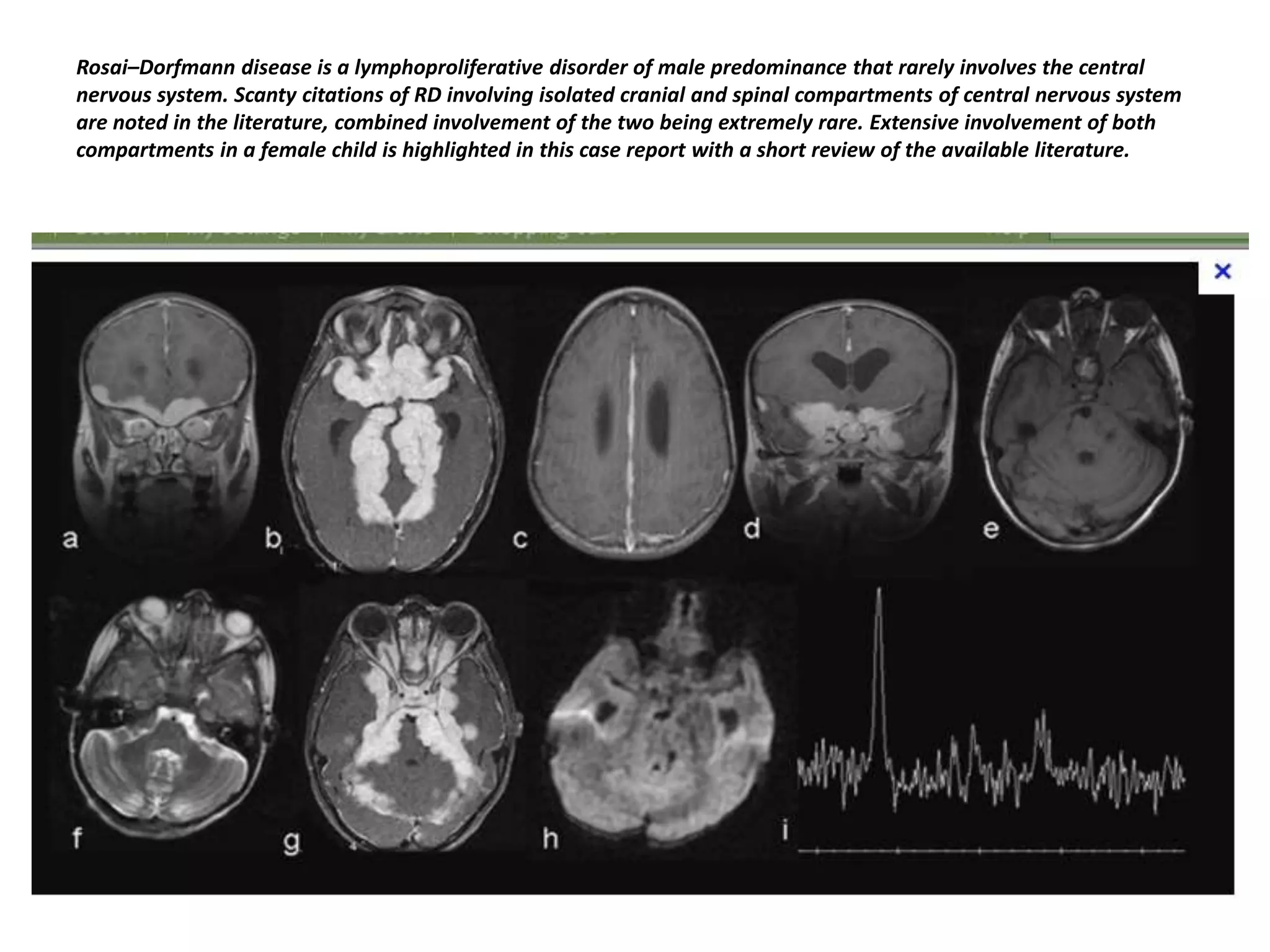 Rosai–Dorfmann disease is a lymphoproliferative disorder of male predominance that rarely involves the central
nervous system. Scanty citations of RD involving isolated cranial and spinal compartments of central nervous system
are noted in the literature, combined involvement of the two being extremely rare. Extensive involvement of both
compartments in a female child is highlighted in this case report with a short review of the available literature.

 