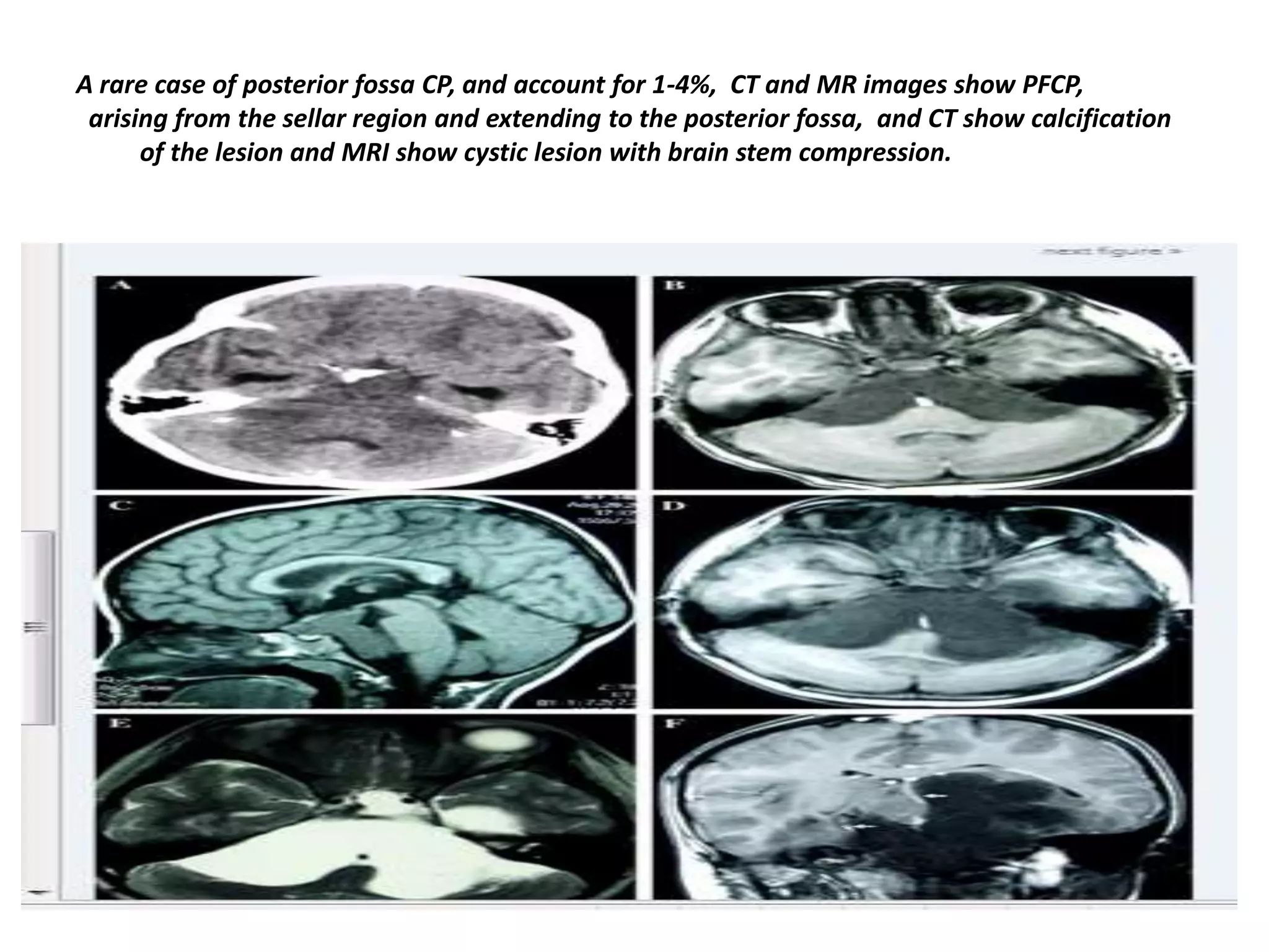A rare case of posterior fossa CP, and account for 1-4%, CT and MR images show PFCP,
arising from the sellar region and extending to the posterior fossa, and CT show calcification
of the lesion and MRI show cystic lesion with brain stem compression.

 