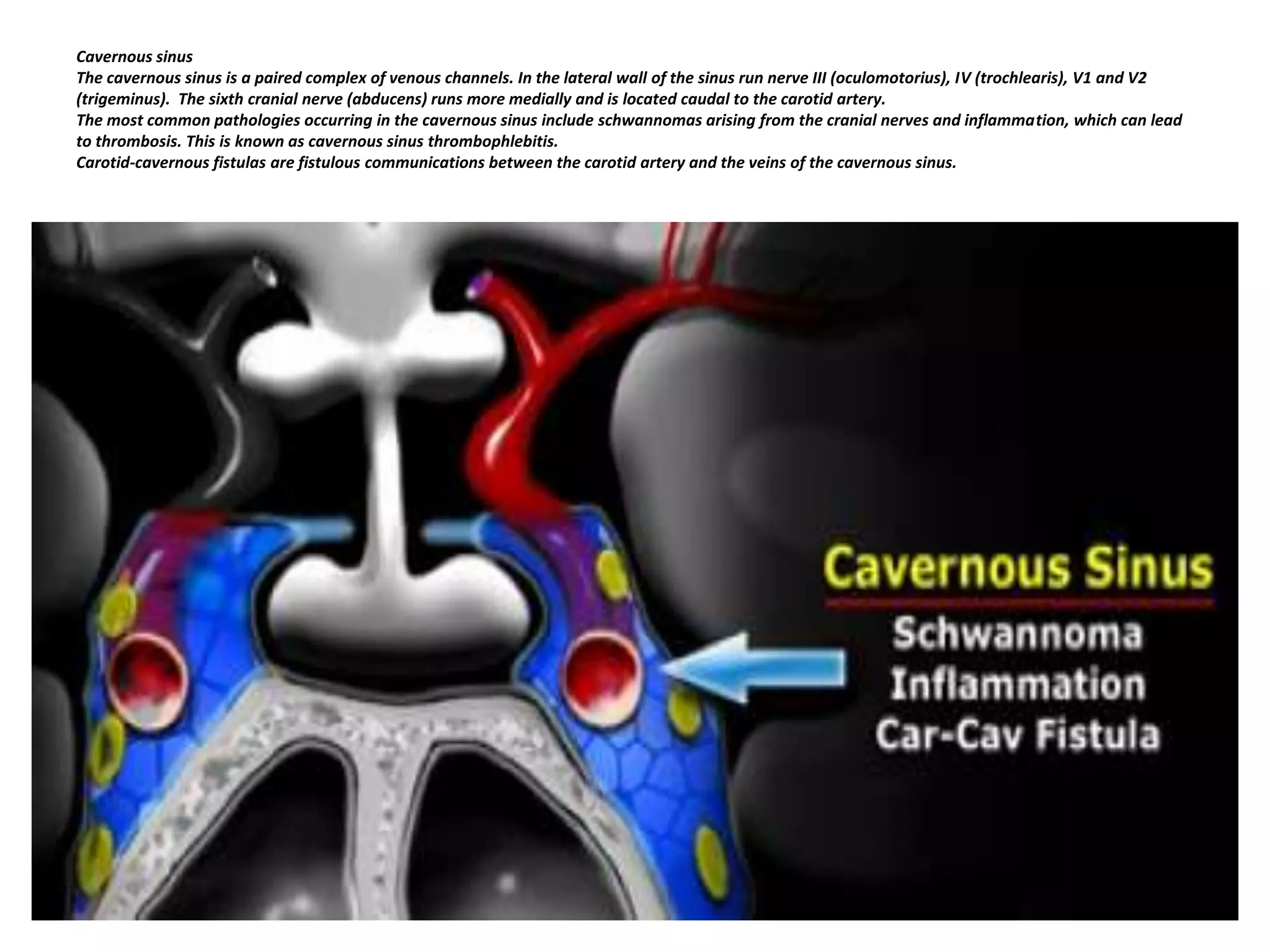 Cavernous sinus
The cavernous sinus is a paired complex of venous channels. In the lateral wall of the sinus run nerve III (oculomotorius), IV (trochlearis), V1 and V2
(trigeminus). The sixth cranial nerve (abducens) runs more medially and is located caudal to the carotid artery.
The most common pathologies occurring in the cavernous sinus include schwannomas arising from the cranial nerves and inflammation, which can lead
to thrombosis. This is known as cavernous sinus thrombophlebitis.
Carotid-cavernous fistulas are fistulous communications between the carotid artery and the veins of the cavernous sinus.

 