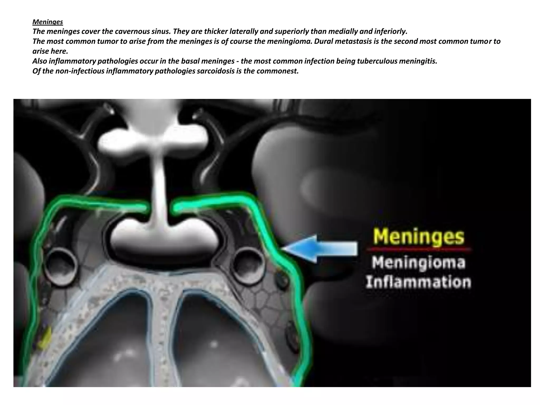 Meninges

The meninges cover the cavernous sinus. They are thicker laterally and superiorly than medially and inferiorly.
The most common tumor to arise from the meninges is of course the meningioma. Dural metastasis is the second most common tumor to
arise here.
Also inflammatory pathologies occur in the basal meninges - the most common infection being tuberculous meningitis.
Of the non-infectious inflammatory pathologies sarcoidosis is the commonest.

 