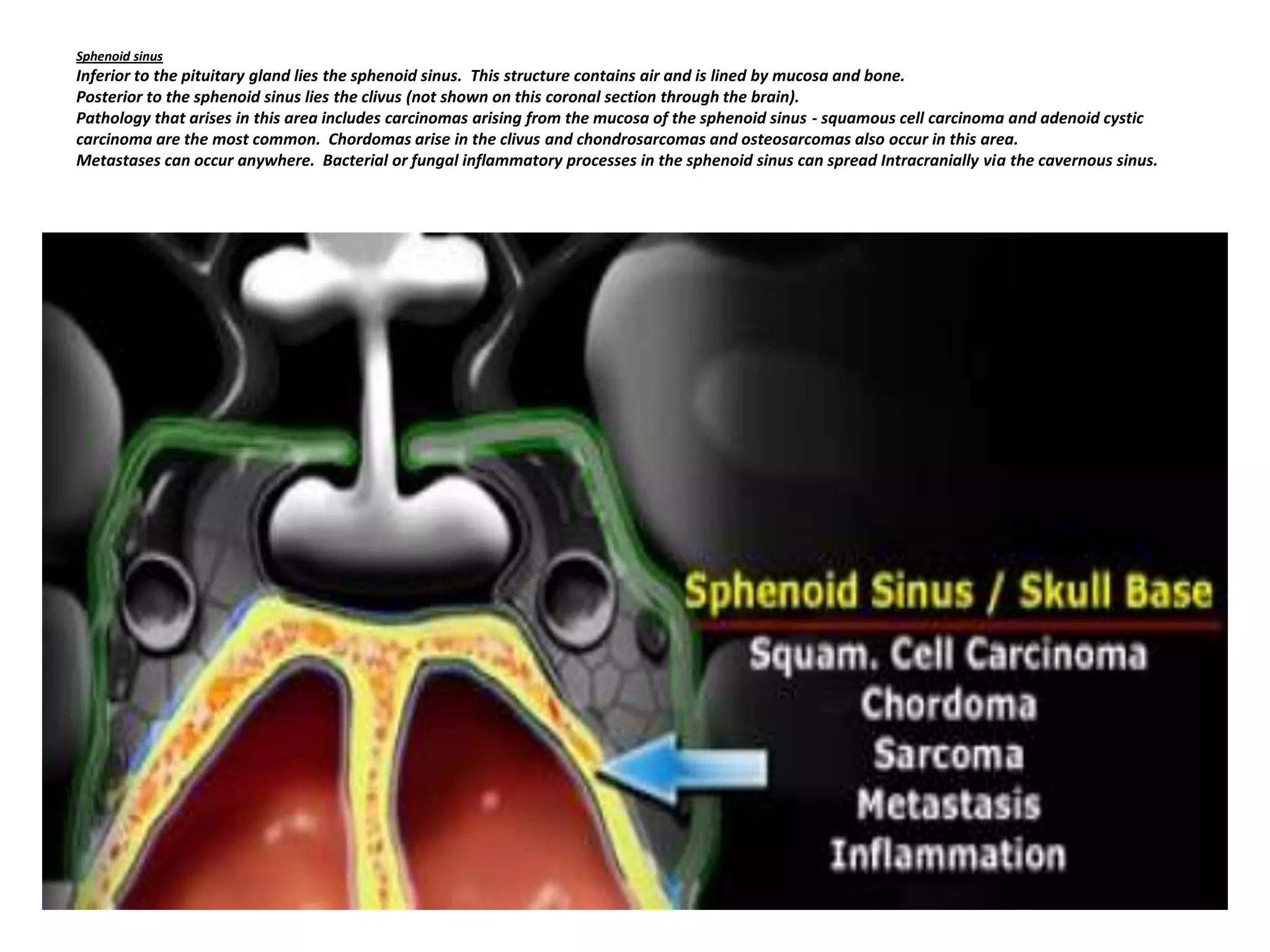 Sphenoid sinus

Inferior to the pituitary gland lies the sphenoid sinus. This structure contains air and is lined by mucosa and bone.
Posterior to the sphenoid sinus lies the clivus (not shown on this coronal section through the brain).
Pathology that arises in this area includes carcinomas arising from the mucosa of the sphenoid sinus - squamous cell carcinoma and adenoid cystic
carcinoma are the most common. Chordomas arise in the clivus and chondrosarcomas and osteosarcomas also occur in this area.
Metastases can occur anywhere. Bacterial or fungal inflammatory processes in the sphenoid sinus can spread Intracranially via the cavernous sinus.

 