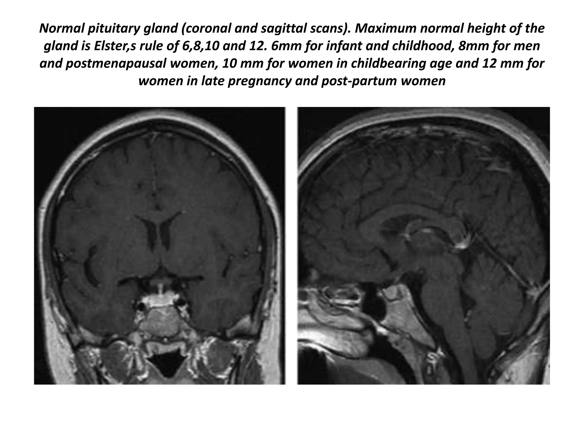 Normal pituitary gland (coronal and sagittal scans). Maximum normal height of the
gland is Elster,s rule of 6,8,10 and 12. 6mm for infant and childhood, 8mm for men
and postmenapausal women, 10 mm for women in childbearing age and 12 mm for
women in late pregnancy and post-partum women

 