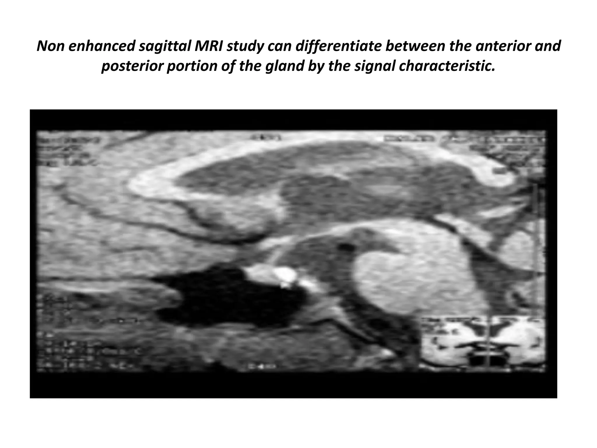 Non enhanced sagittal MRI study can differentiate between the anterior and
posterior portion of the gland by the signal characteristic.

 