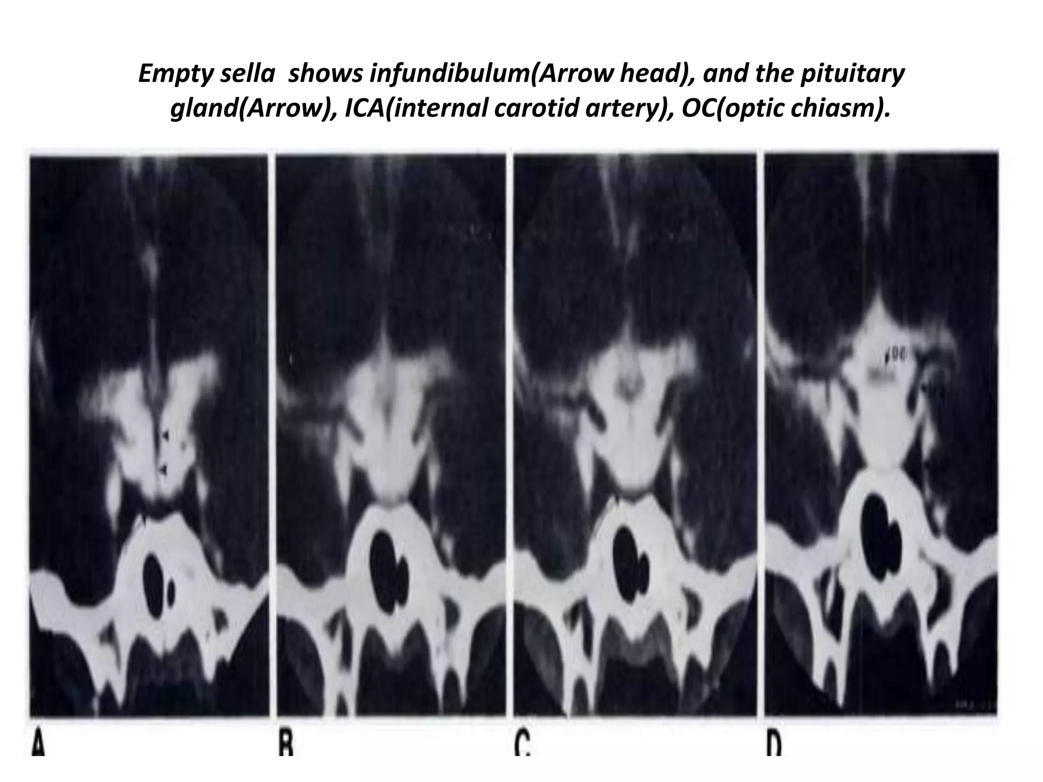 Empty sella shows infundibulum(Arrow head), and the pituitary
gland(Arrow), ICA(internal carotid artery), OC(optic chiasm).

 