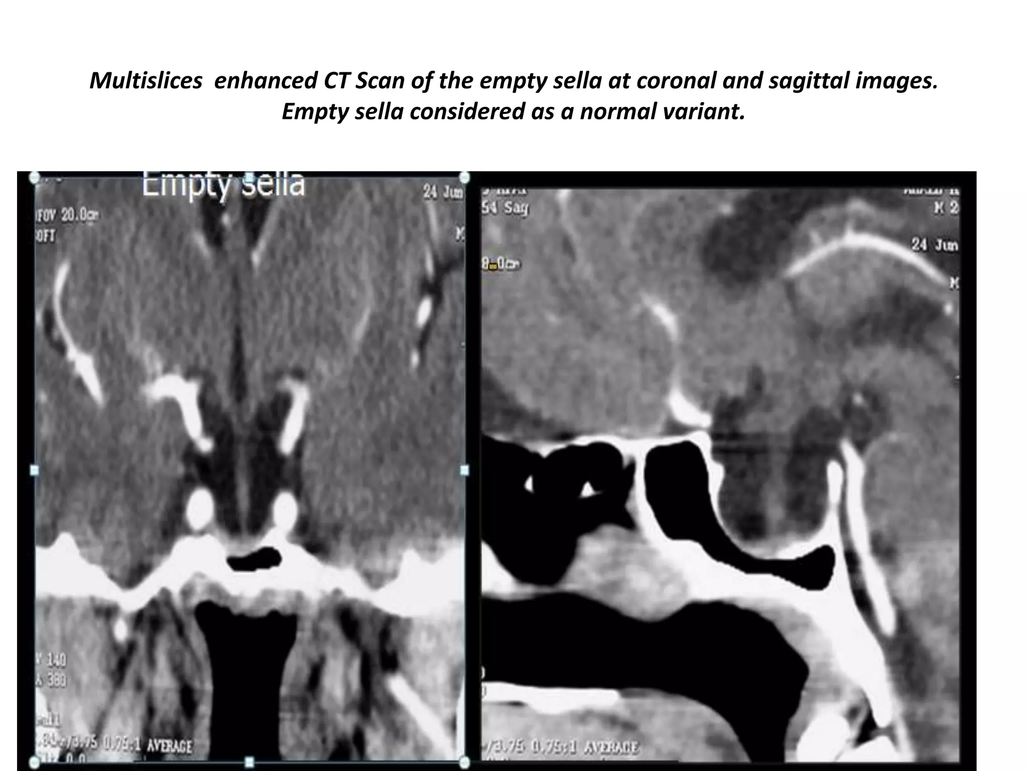 Multislices enhanced CT Scan of the empty sella at coronal and sagittal images.
Empty sella considered as a normal variant.

 