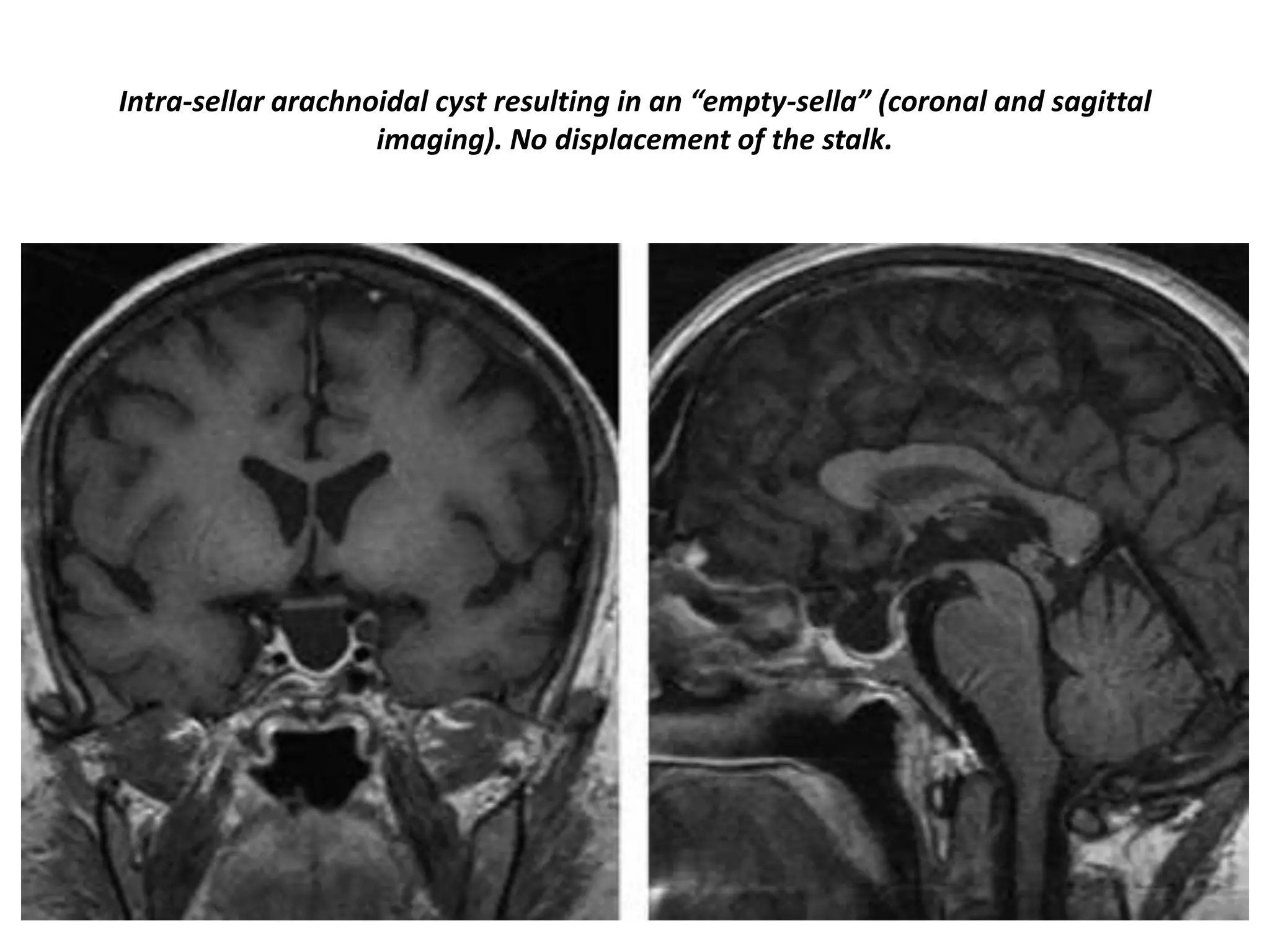 Intra-sellar arachnoidal cyst resulting in an “empty-sella” (coronal and sagittal
imaging). No displacement of the stalk.

 