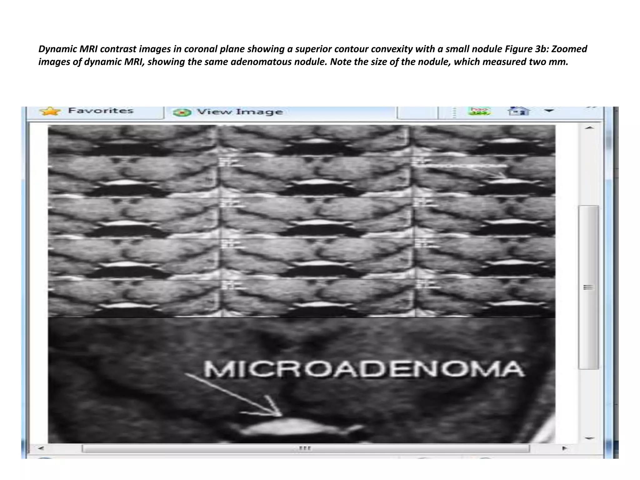 Dynamic MRI contrast images in coronal plane showing a superior contour convexity with a small nodule Figure 3b: Zoomed
images of dynamic MRI, showing the same adenomatous nodule. Note the size of the nodule, which measured two mm.

 