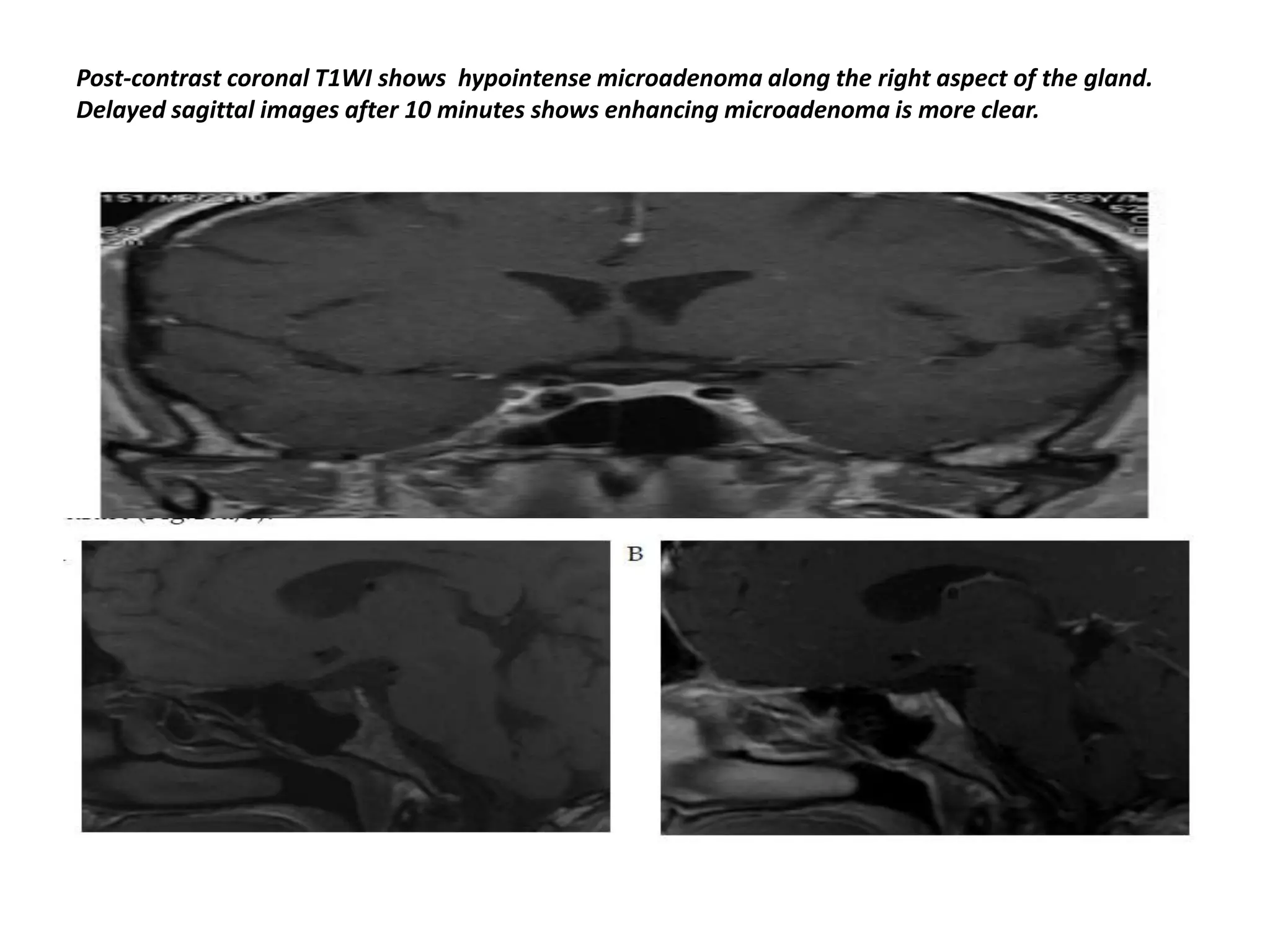Post-contrast coronal T1WI shows hypointense microadenoma along the right aspect of the gland.
Delayed sagittal images after 10 minutes shows enhancing microadenoma is more clear.

 