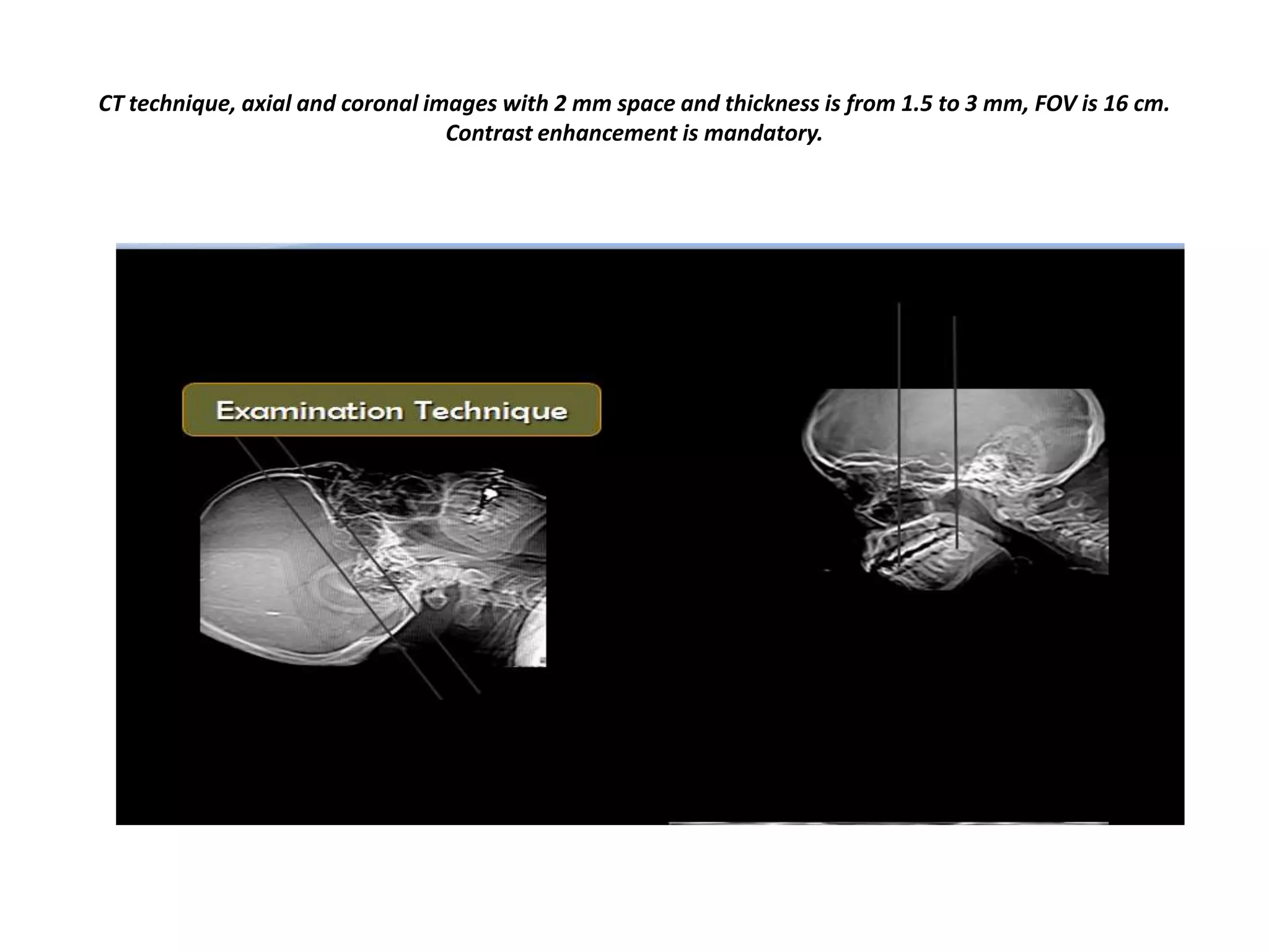CT technique, axial and coronal images with 2 mm space and thickness is from 1.5 to 3 mm, FOV is 16 cm.
Contrast enhancement is mandatory.

 