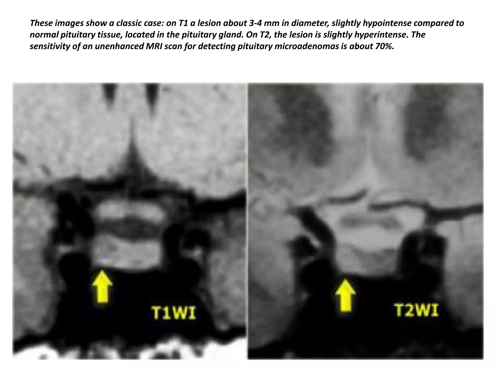 These images show a classic case: on T1 a lesion about 3-4 mm in diameter, slightly hypointense compared to
normal pituitary tissue, located in the pituitary gland. On T2, the lesion is slightly hyperintense. The
sensitivity of an unenhanced MRI scan for detecting pituitary microadenomas is about 70%.

 