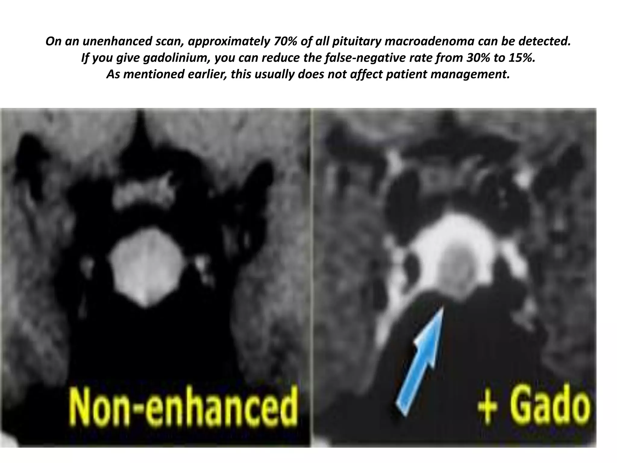 On an unenhanced scan, approximately 70% of all pituitary macroadenoma can be detected.
If you give gadolinium, you can reduce the false-negative rate from 30% to 15%.
As mentioned earlier, this usually does not affect patient management.

 