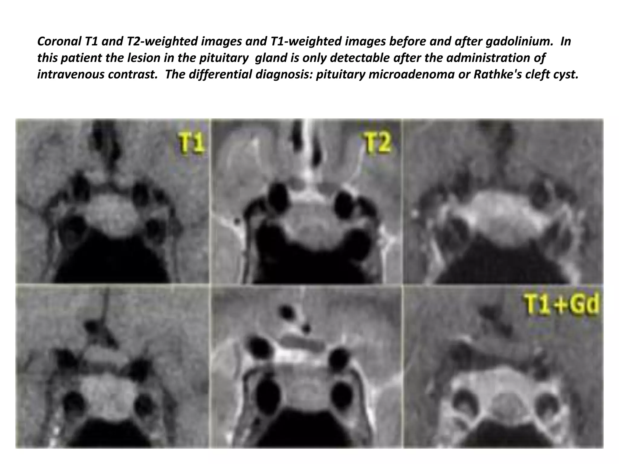 Coronal T1 and T2-weighted images and T1-weighted images before and after gadolinium. In
this patient the lesion in the pituitary gland is only detectable after the administration of
intravenous contrast. The differential diagnosis: pituitary microadenoma or Rathke's cleft cyst.

 