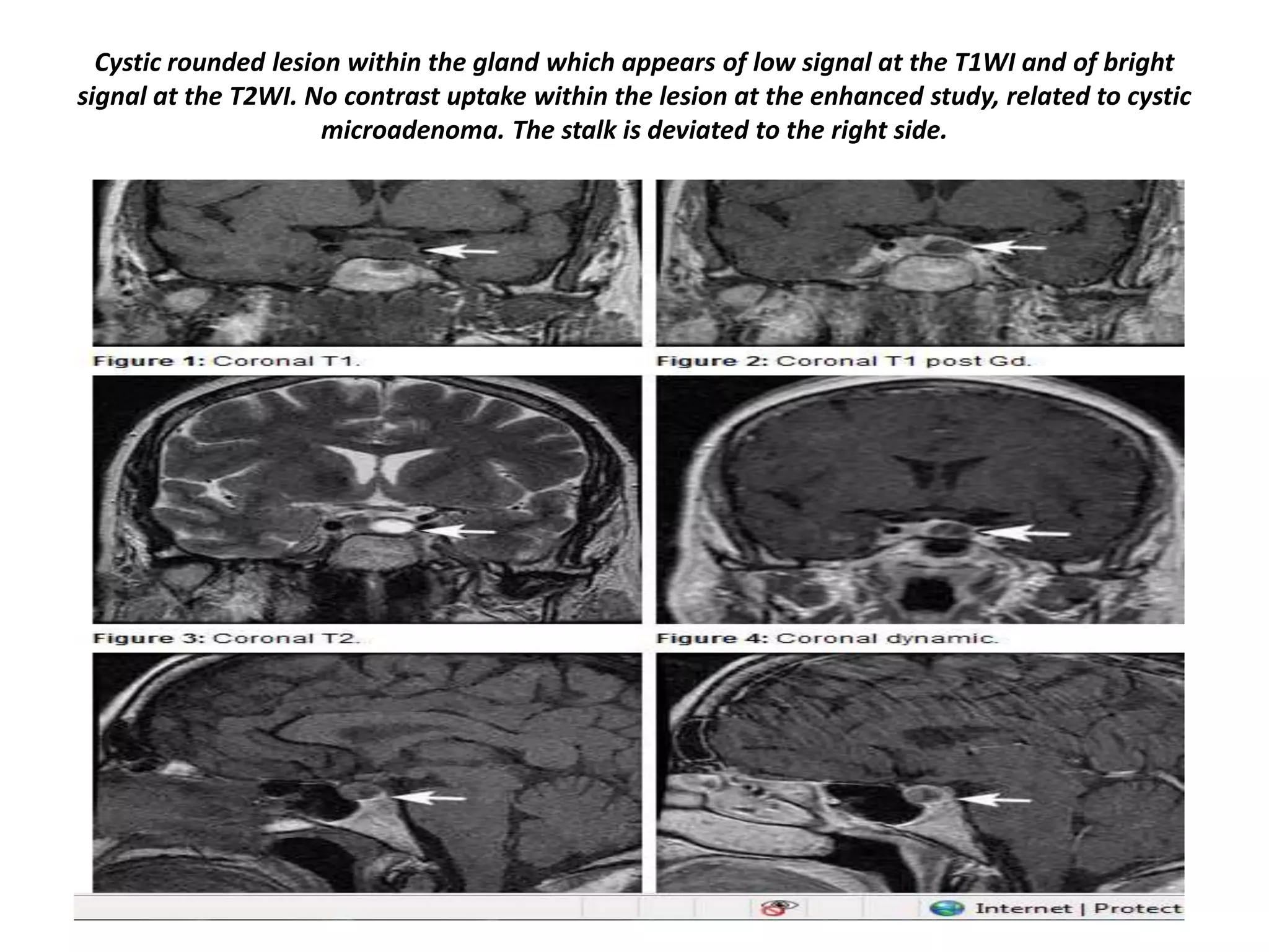 Cystic rounded lesion within the gland which appears of low signal at the T1WI and of bright
signal at the T2WI. No contrast uptake within the lesion at the enhanced study, related to cystic
microadenoma. The stalk is deviated to the right side.

 