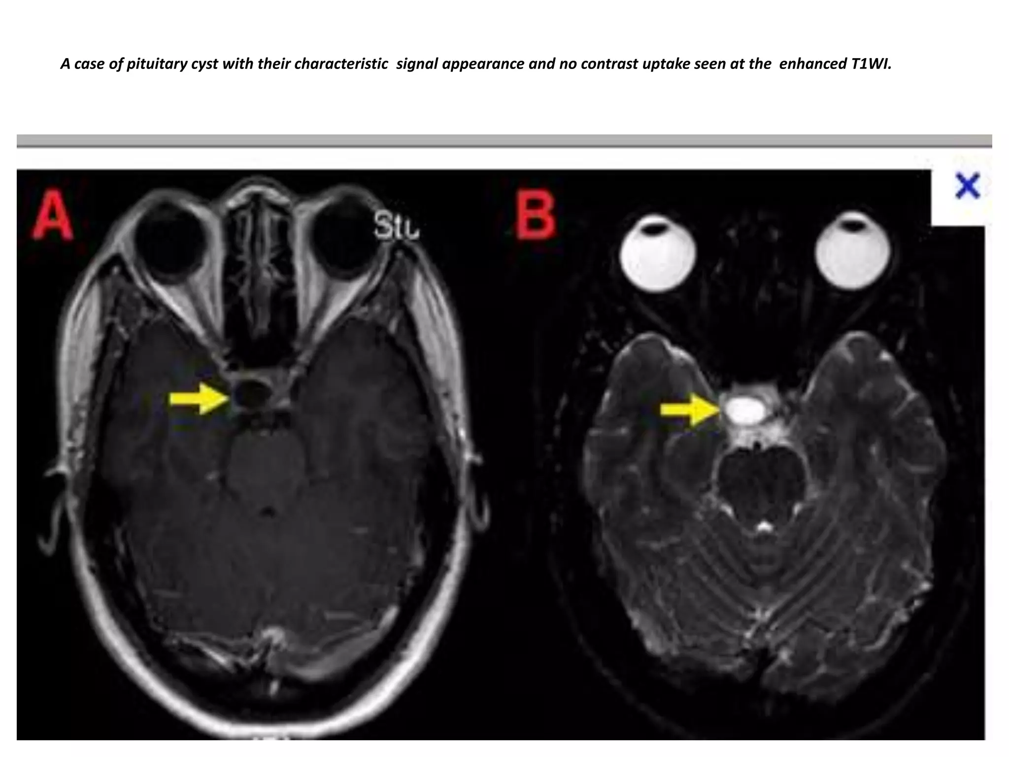 A case of pituitary cyst with their characteristic signal appearance and no contrast uptake seen at the enhanced T1WI.

 