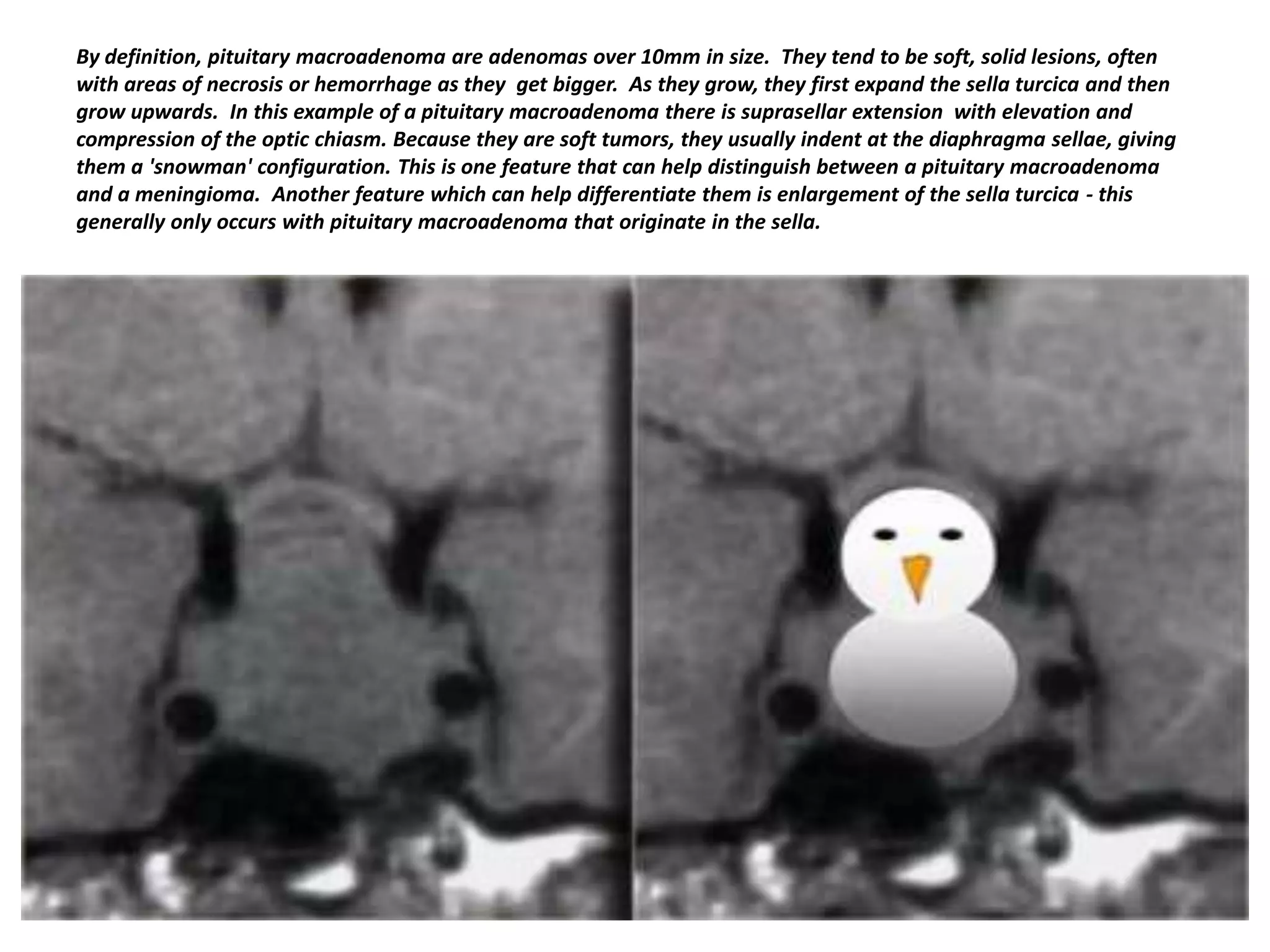 By definition, pituitary macroadenoma are adenomas over 10mm in size. They tend to be soft, solid lesions, often
with areas of necrosis or hemorrhage as they get bigger. As they grow, they first expand the sella turcica and then
grow upwards. In this example of a pituitary macroadenoma there is suprasellar extension with elevation and
compression of the optic chiasm. Because they are soft tumors, they usually indent at the diaphragma sellae, giving
them a 'snowman' configuration. This is one feature that can help distinguish between a pituitary macroadenoma
and a meningioma. Another feature which can help differentiate them is enlargement of the sella turcica - this
generally only occurs with pituitary macroadenoma that originate in the sella.

 