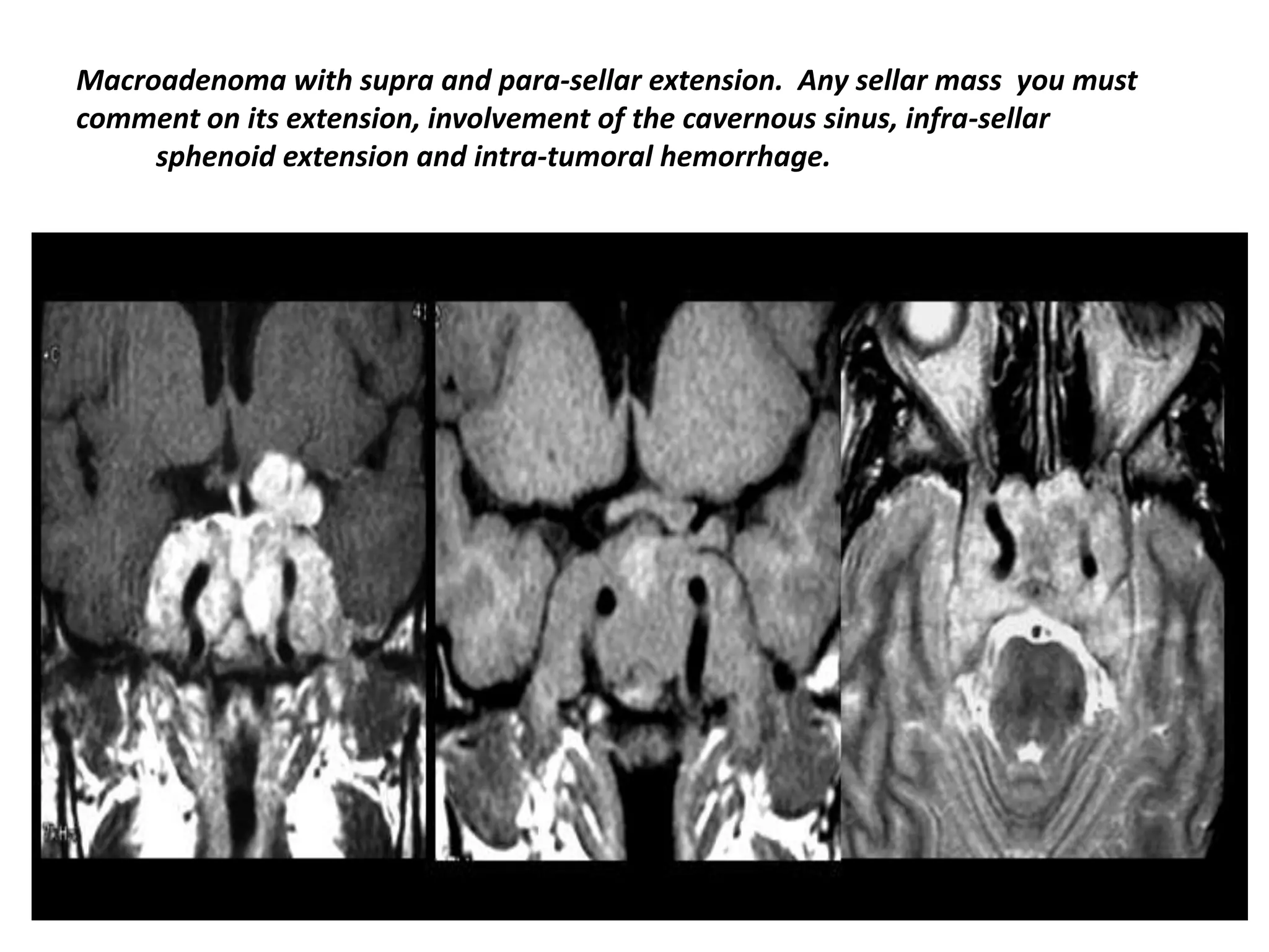 Macroadenoma with supra and para-sellar extension. Any sellar mass you must
comment on its extension, involvement of the cavernous sinus, infra-sellar
sphenoid extension and intra-tumoral hemorrhage.

 