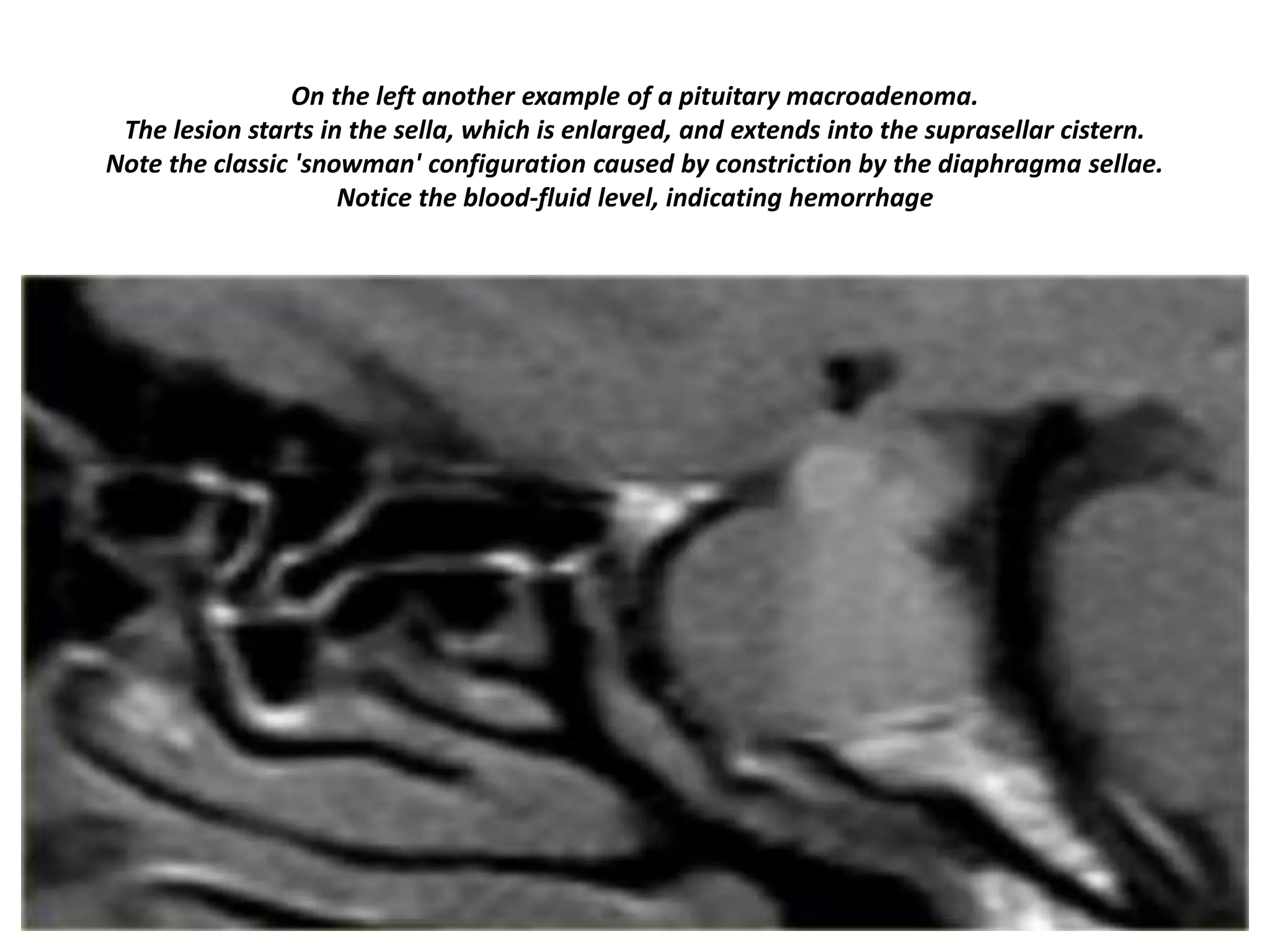 On the left another example of a pituitary macroadenoma.
The lesion starts in the sella, which is enlarged, and extends into the suprasellar cistern.
Note the classic 'snowman' configuration caused by constriction by the diaphragma sellae.
Notice the blood-fluid level, indicating hemorrhage

 