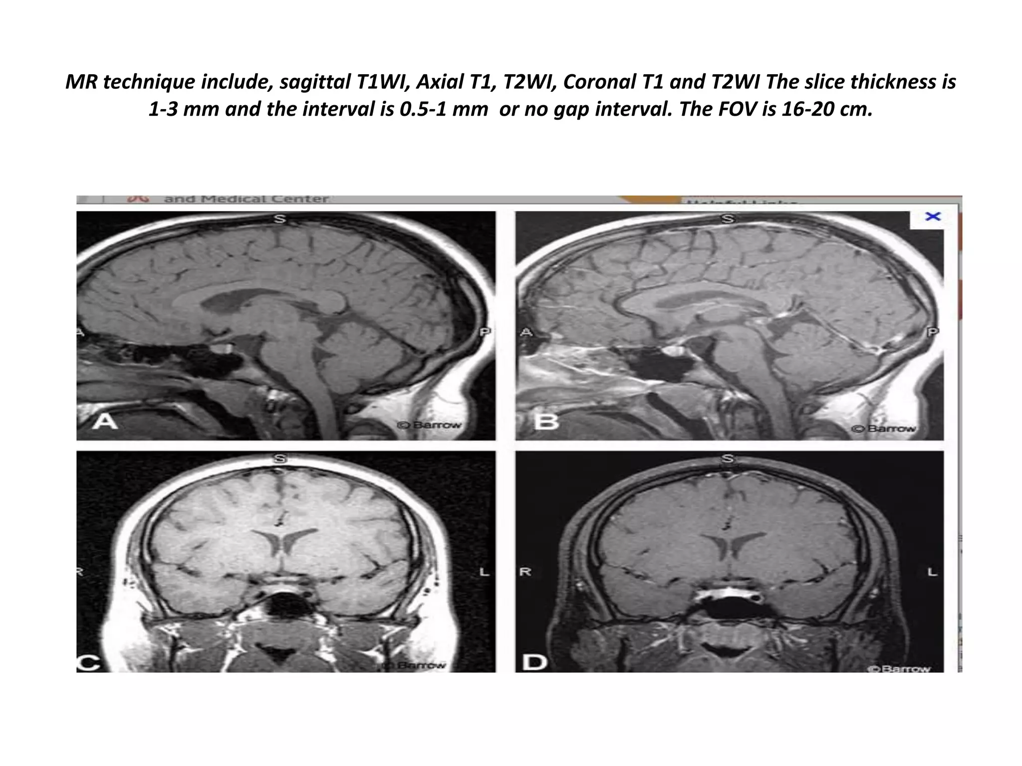 MR technique include, sagittal T1WI, Axial T1, T2WI, Coronal T1 and T2WI The slice thickness is
1-3 mm and the interval is 0.5-1 mm or no gap interval. The FOV is 16-20 cm.

 