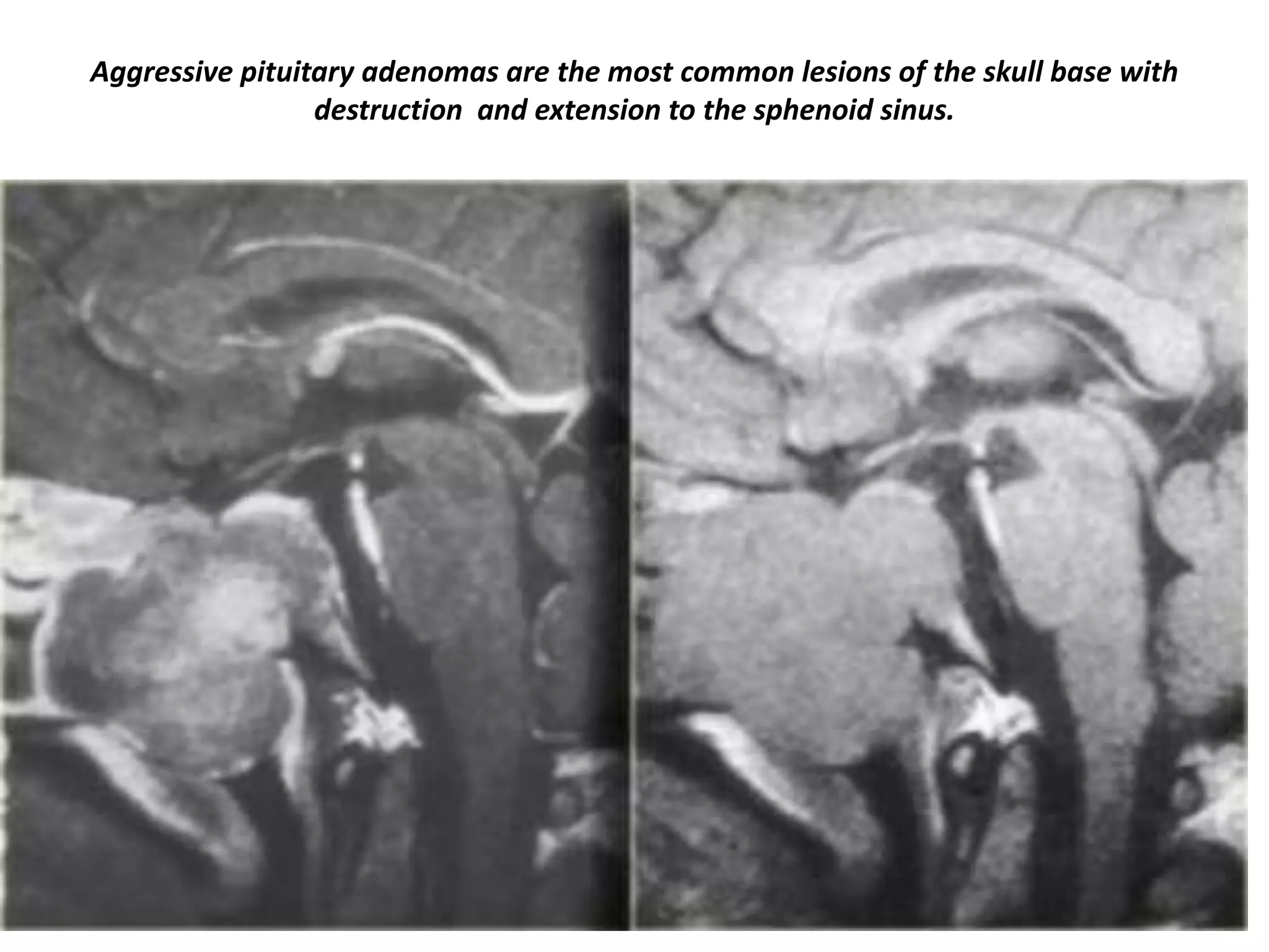 Aggressive pituitary adenomas are the most common lesions of the skull base with
destruction and extension to the sphenoid sinus.

 