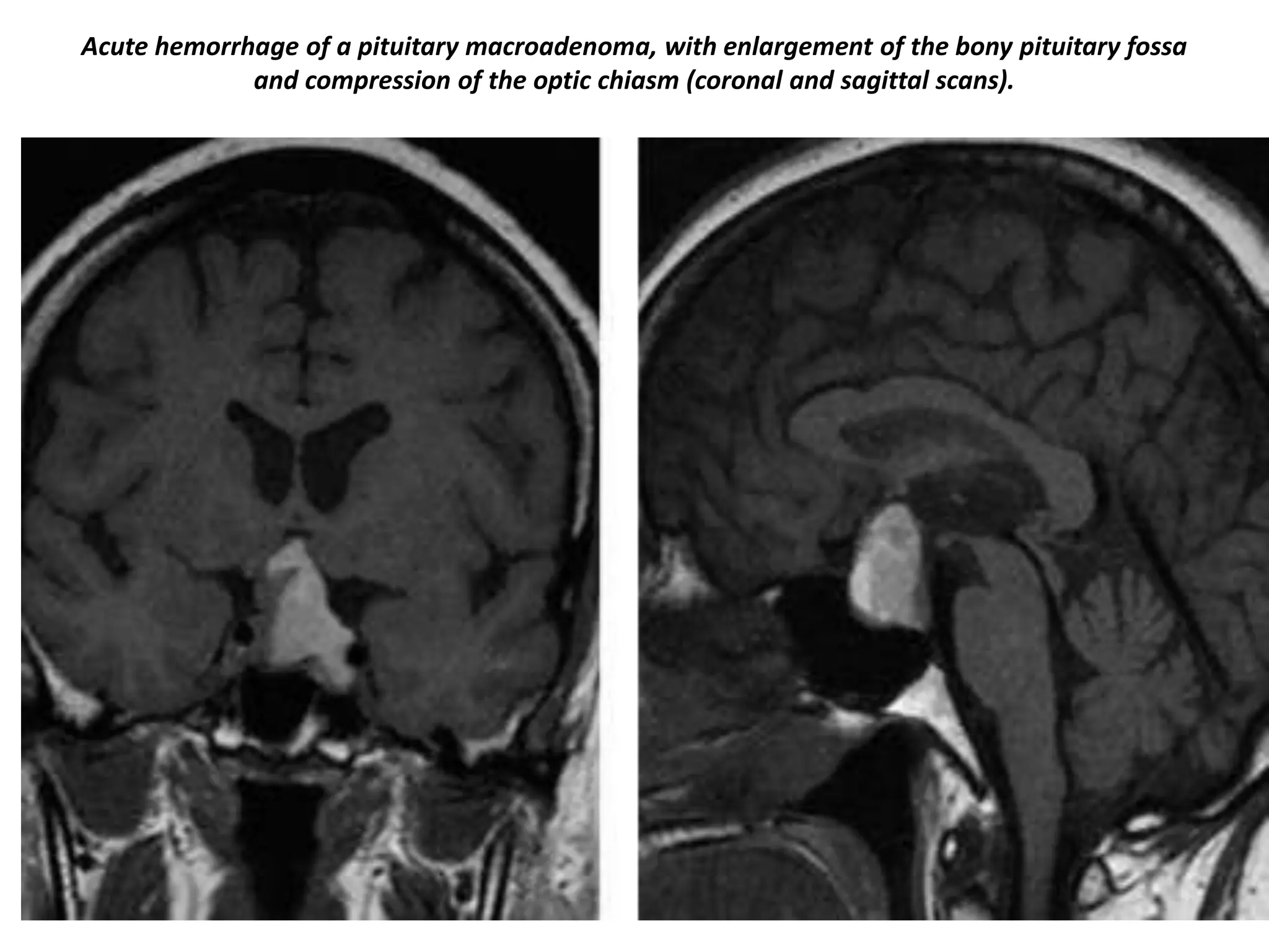 Acute hemorrhage of a pituitary macroadenoma, with enlargement of the bony pituitary fossa
and compression of the optic chiasm (coronal and sagittal scans).

 