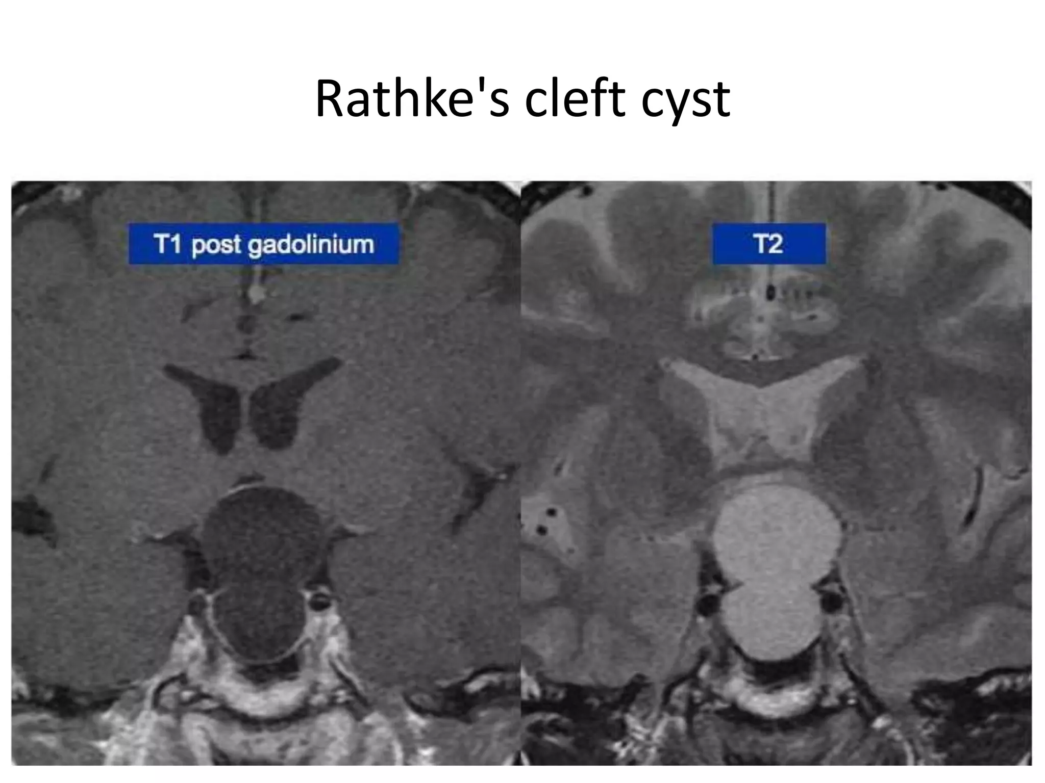 Rathke's cleft cyst

 