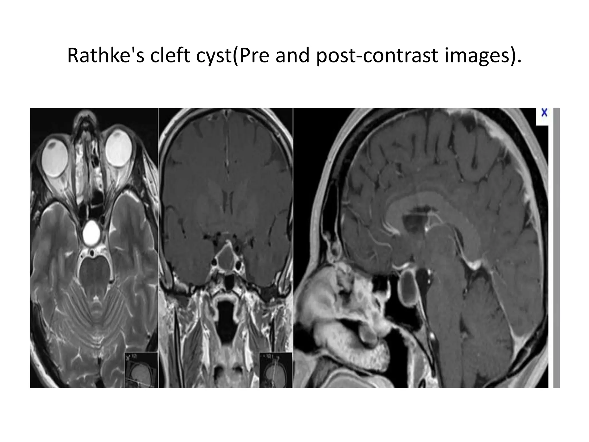 Rathke's cleft cyst(Pre and post-contrast images).

 