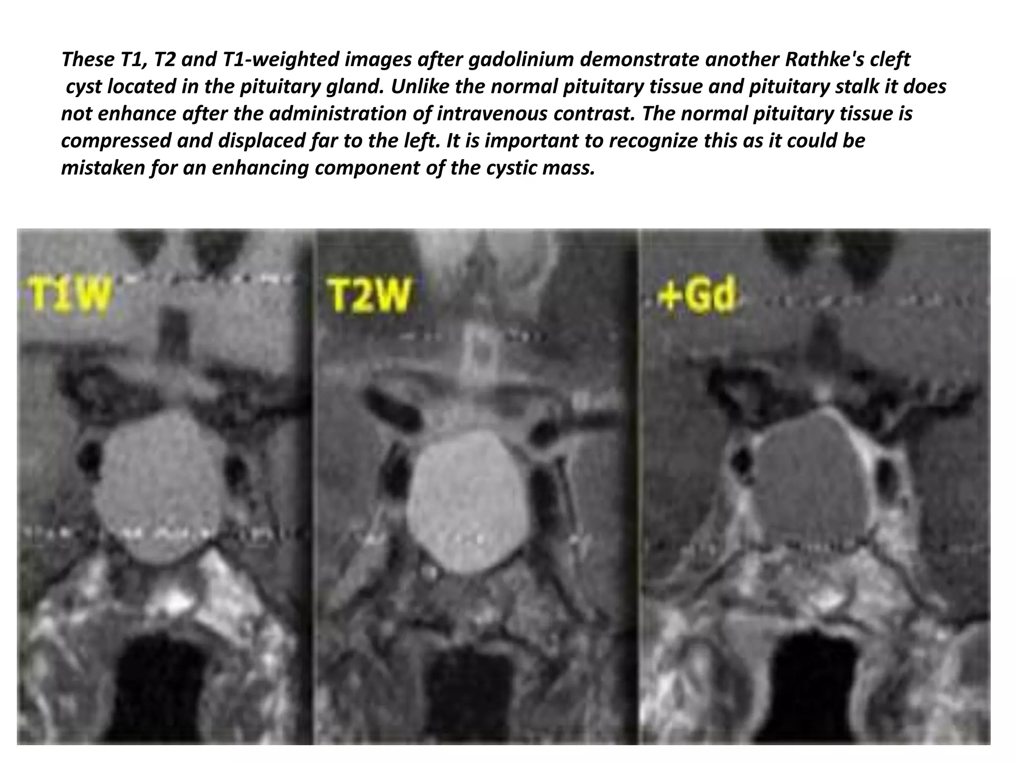 These T1, T2 and T1-weighted images after gadolinium demonstrate another Rathke's cleft
cyst located in the pituitary gland. Unlike the normal pituitary tissue and pituitary stalk it does
not enhance after the administration of intravenous contrast. The normal pituitary tissue is
compressed and displaced far to the left. It is important to recognize this as it could be
mistaken for an enhancing component of the cystic mass.

 
