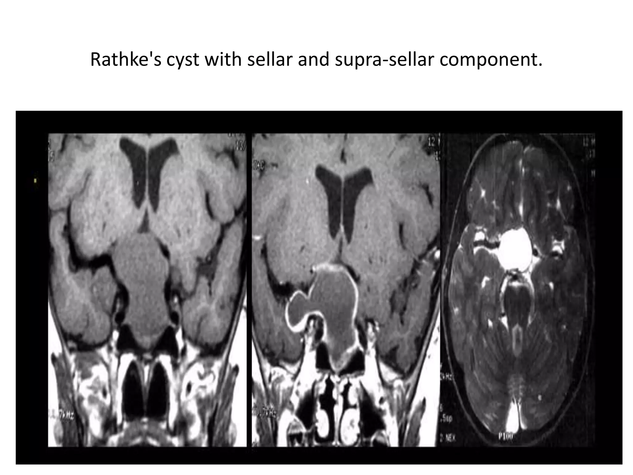Rathke's cyst with sellar and supra-sellar component.

 