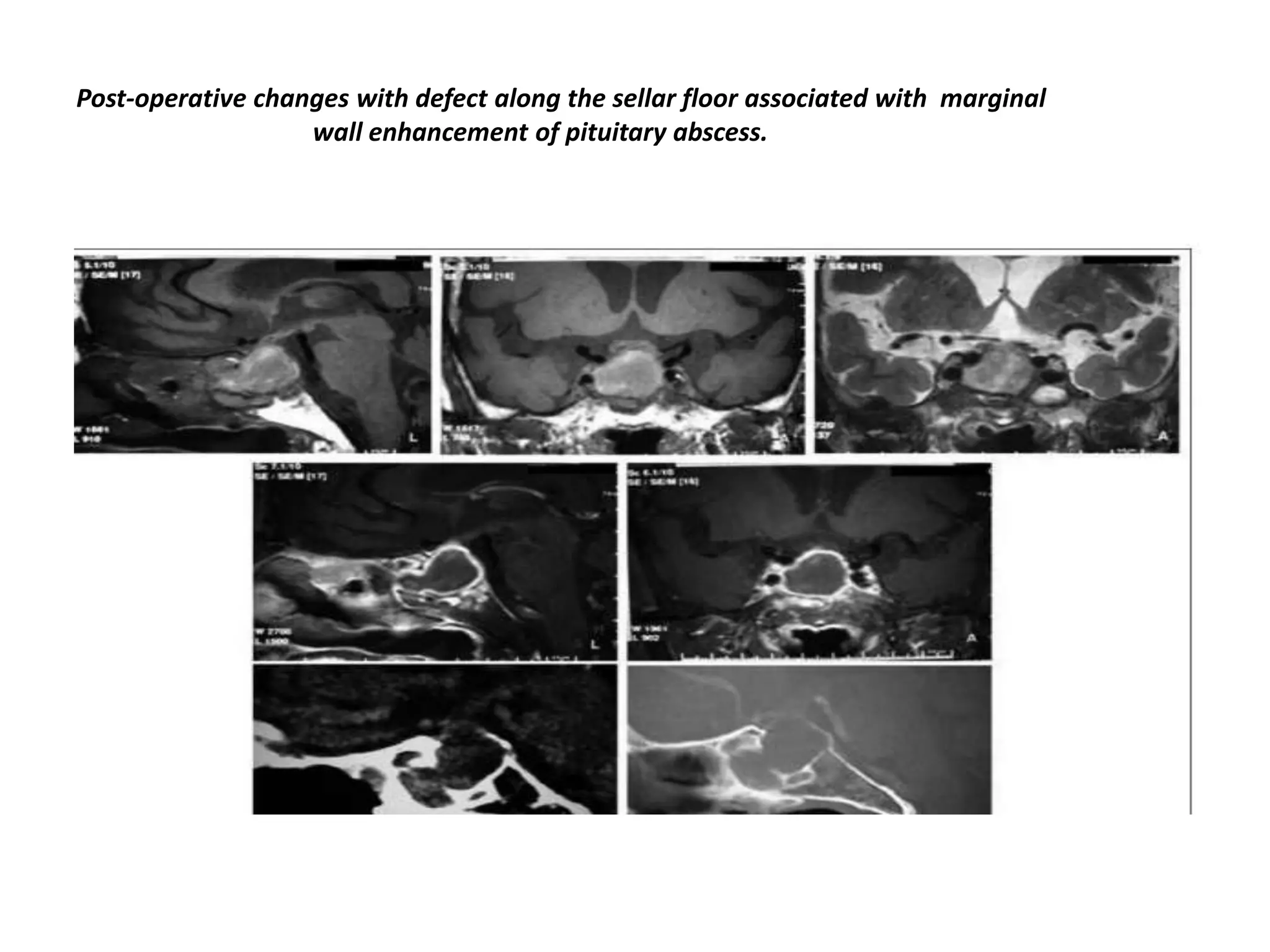 Post-operative changes with defect along the sellar floor associated with marginal
wall enhancement of pituitary abscess.

 